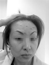 上海一女子就餐時干鍋爆炸致面部眼部被灼傷