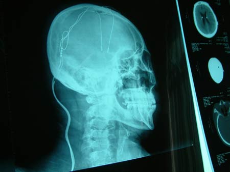 帕金森癥男子數次想自殺 腦袋植入電極獲得康復