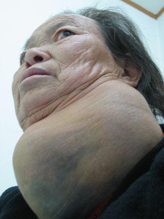 六旬老太脖上大肉瘤生長40年 一直垂到胸脯(圖)