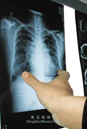 18歲小伙心臟超大是正常人6倍 說話就冒汗(圖)